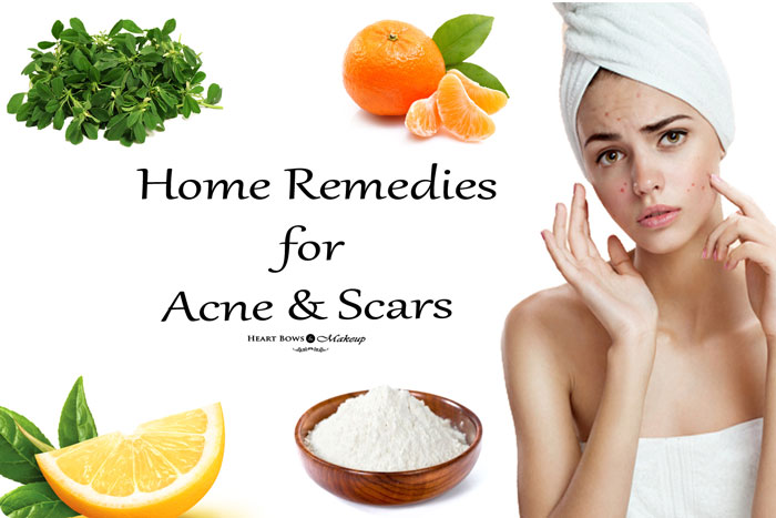 ব্রণ দূর করার ১৩টি ঘরোয়া উপায়। 13 Home Remedies for Acne